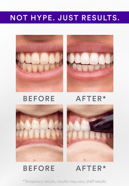✨ODALIT™ V34 Whitening Strips -Radiate a beautiful smile
